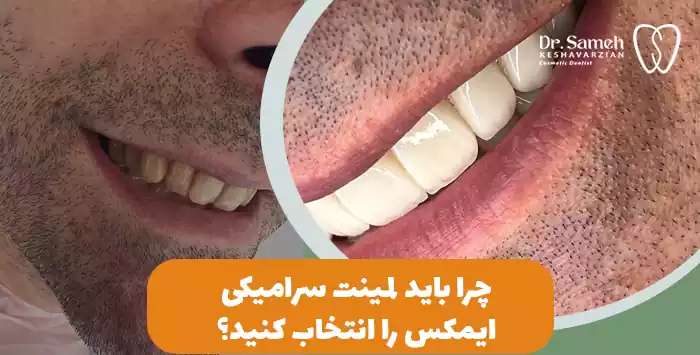 چرا باید لمینت‌ سرامیکی ایمکس را انتخاب کنید؟