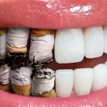 تاثیر سیگار بر لمینت دندان