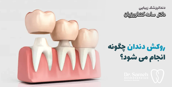 روکش دندان چگونه انجام می شود؟