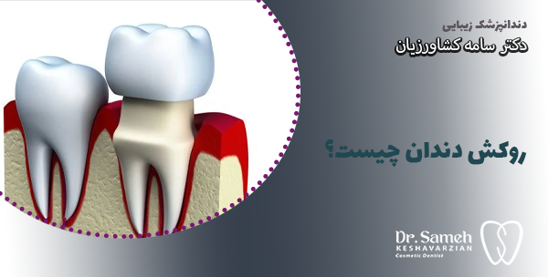 روکش دندان چیست