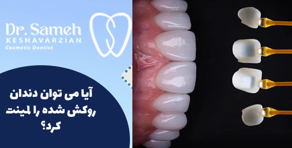 آیا می توان دندان روکش شده را لمینت کرد؟