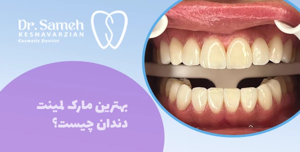 بهترین مارک لمینت دندان چیست؟
