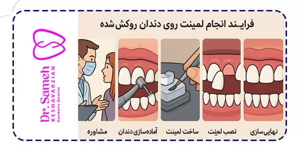 فرایند انجام لمینت روی دندان روکش‌ شده