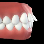 لمینت دندان خرگوشی