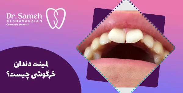 لمینت دندان خرگوشی چیست؟