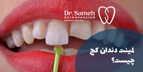 لمینت دندان کج چیست؟