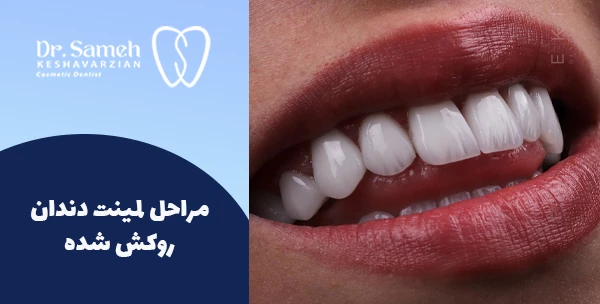 مراحل لمینت دندان روکش شده 