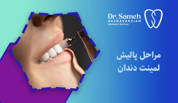 مراحل پالیش لمینت دندان