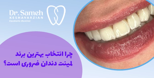 چرا انتخاب بهترین برند لمینت دندان ضروری است؟