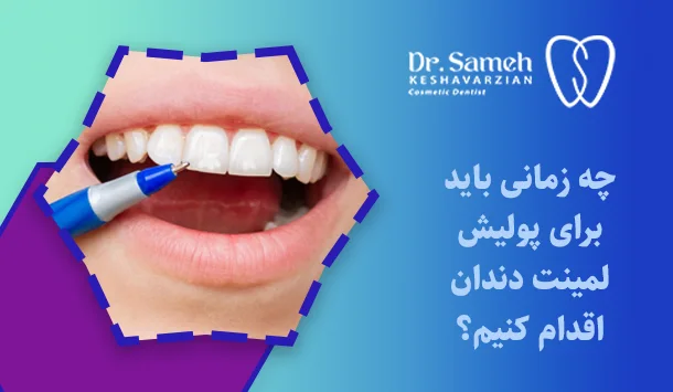 چه زمانی باید برای پولیش لمینت دندان اقدام کنیم؟