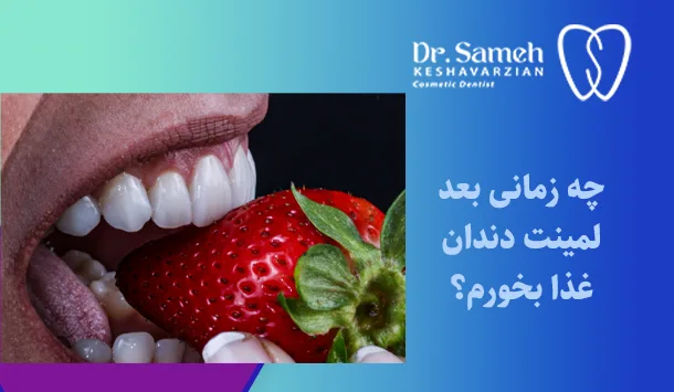 چه زمانی بعد لمینت دندان غذا بخورم؟