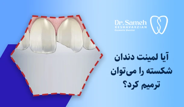 آیا لمینت دندان شکسته را می‌توان ترمیم کرد؟