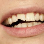 افتادن و شکستن لمینت دندان