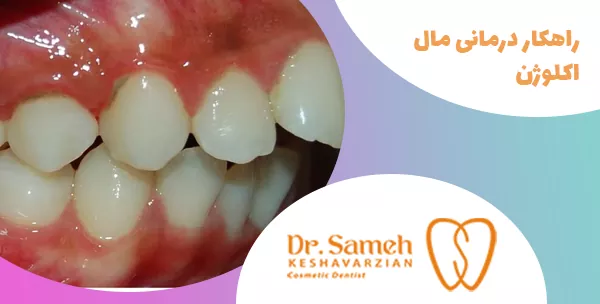 راهکار درمانی مال اکلوژن