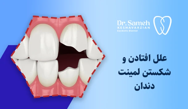علل افتادن و شکستن لمینت دندان
