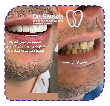 قبل و لمینت دندان
