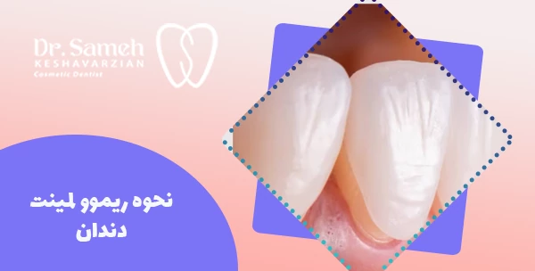 نحوه ریموو لمینت دندان