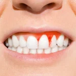 التهاب لثه بعد لمینت دندان