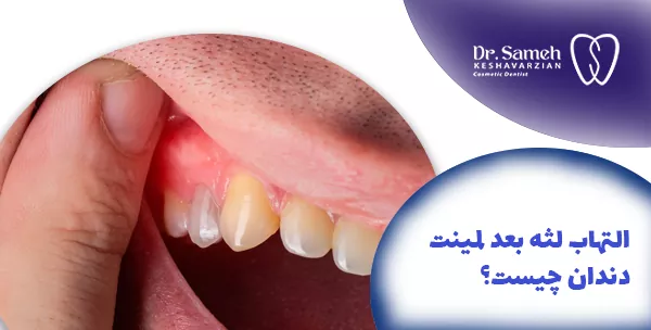 التهاب لثه بعد لمینت دندان چیست؟