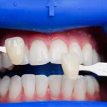 تفاوت بلیچینگ و لمینت دندان