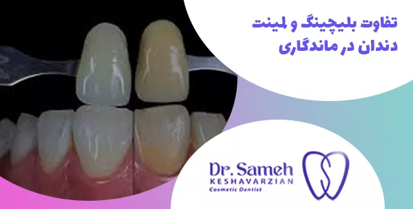 تفاوت بلیچینگ و لمینت دندان در ماندگاری