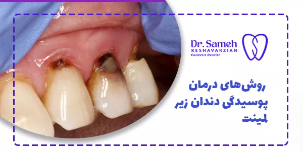  روش‌های درمان پوسیدگی دندان زیر لمینت