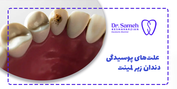  علت‌های پوسیدگی دندان زیر لمینت