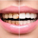 پوسیدگی دندان زیر لمینت
