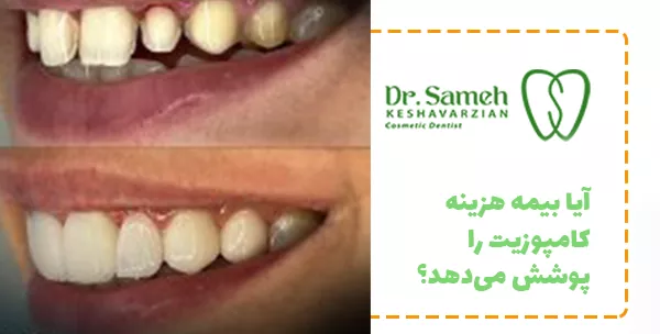 آیا بیمه هزینه کامپوزیت را پوشش می‌دهد؟