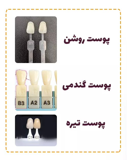 تاثیر رنگ پوست در انتخاب رنگ کامپوزیت