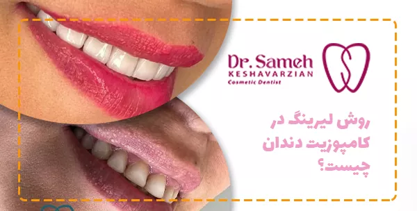 روش لیرینگ در کامپوزیت دندان چیست؟