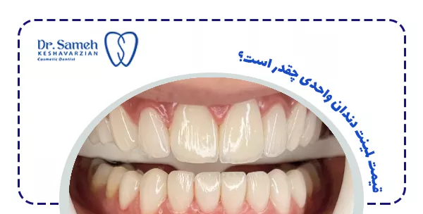قیمت لمینت دندان واحدی چقدر است؟ قیمت لمینت دندان واحدی چقدر است؟