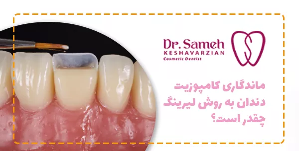 ماندگاری کامپوزیت دندان به روش لیرینگ چقدر است؟