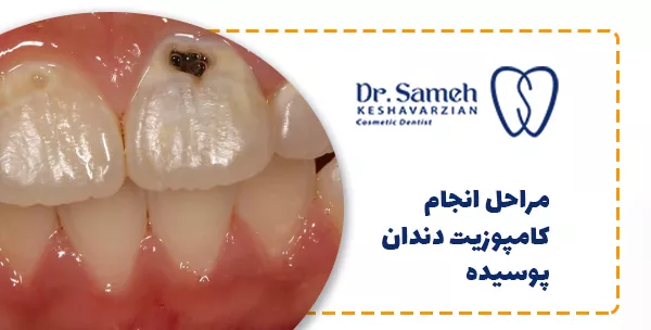 مراحل انجام کامپوزیت دندان پوسیده
