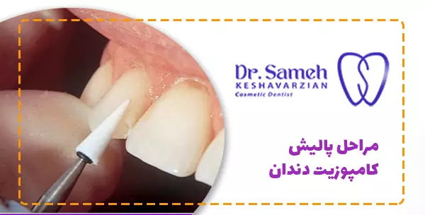 مراحل پالیش کامپوزیت دندان