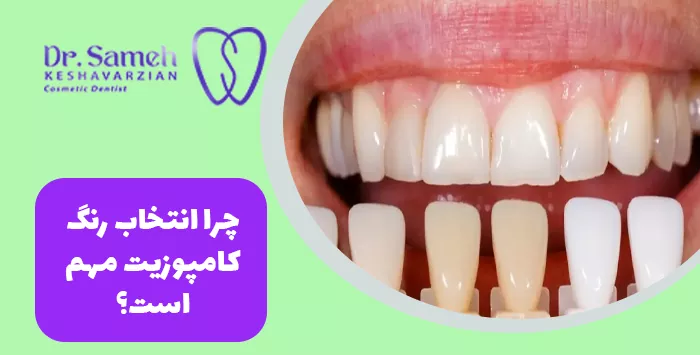 چرا انتخاب رنگ کامپوزیت مهم است؟