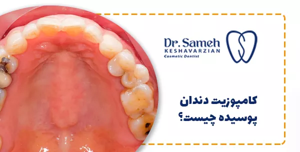 کامپوزیت دندان پوسیده چیست؟