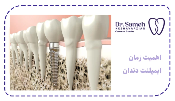 اهمیت زمان ایمپلنت دندان
