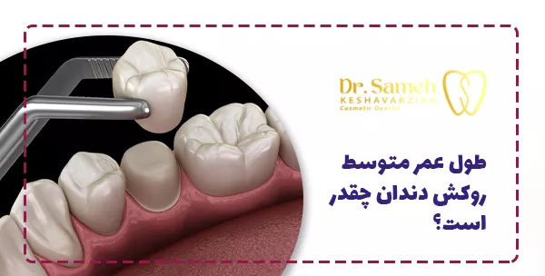 طول عمر متوسط روکش دندان چقدر است؟