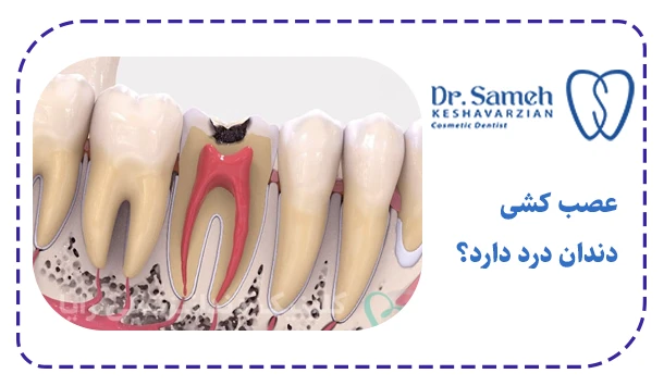 عصب کشی دندان درد دارد؟