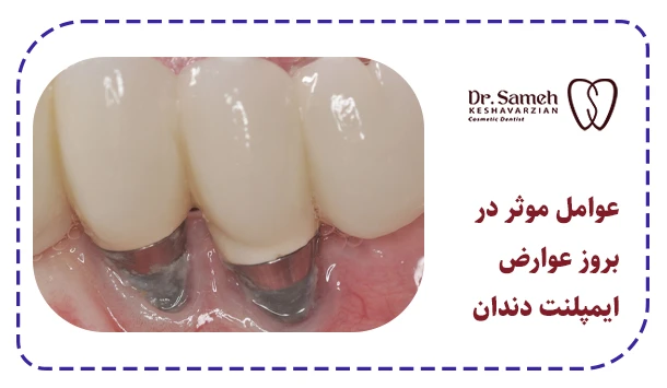 عوامل موثر در بروز عوارض ایمپلنت دندان