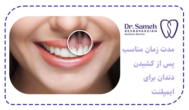 مدت زمان مناسب پس از کشیدن دندان برای ایمپلنت