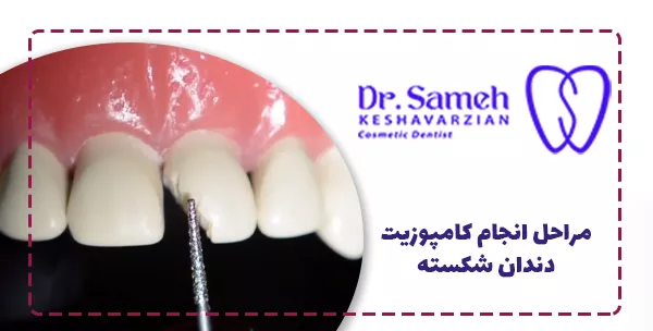 مراحل انجام کامپوزیت دندان شکسته