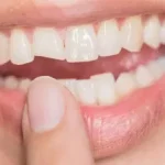 کامپوزیت دندان شکسته