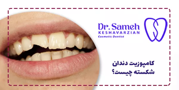 کامپوزیت دندان شکسته چیست؟