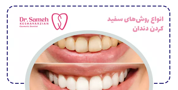 انواع روش‌های سفید کردن دندان