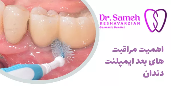 اهمیت مراقبت های بعد ایمپلنت دندان