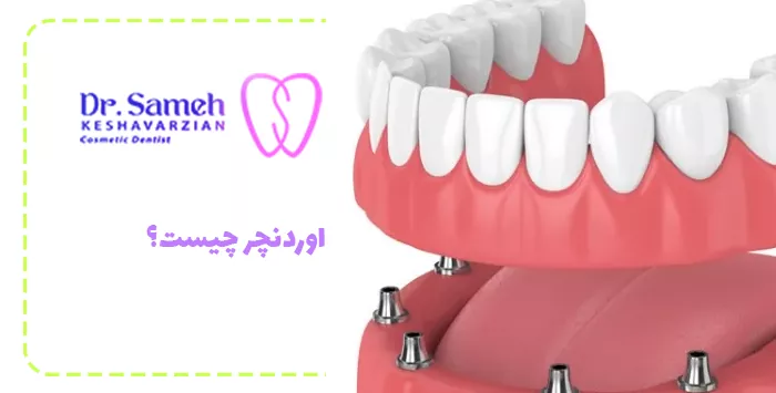 اوردنچر چیست؟