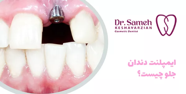 ایمپلنت دندان جلو چیست؟
