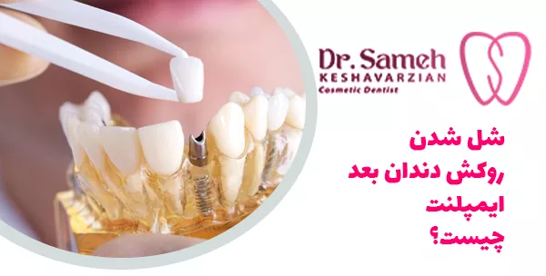 شل شدن روکش دندان بعد ایمپلنت چیست؟